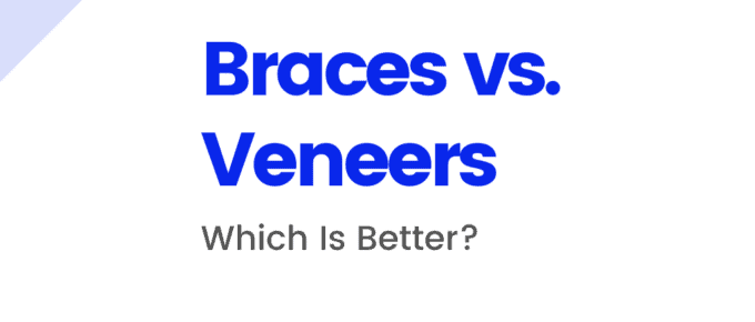 Braces vs Veneers
